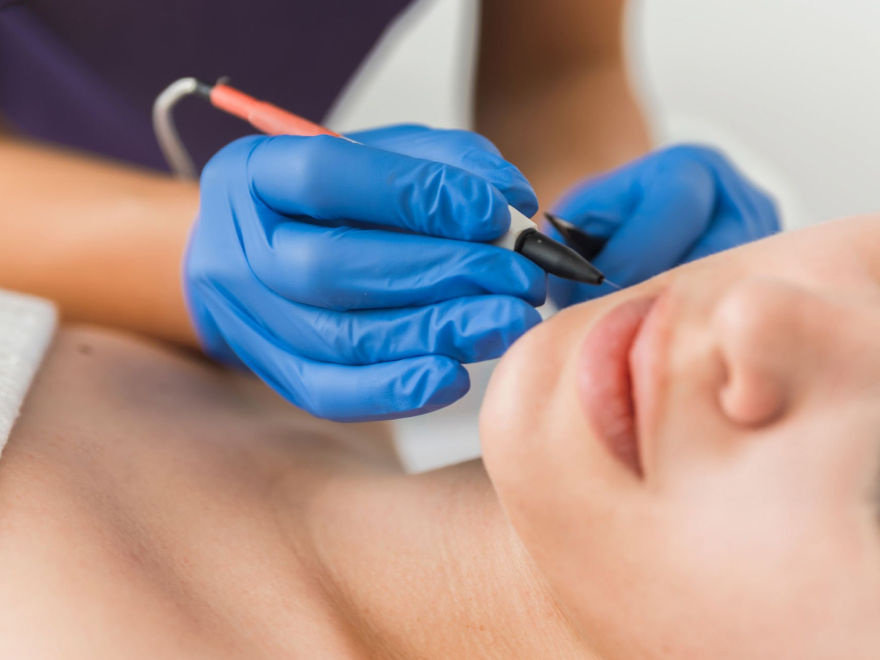 Épilation électrique visage