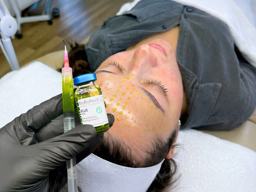 Peeling BioRePeel pigmentation