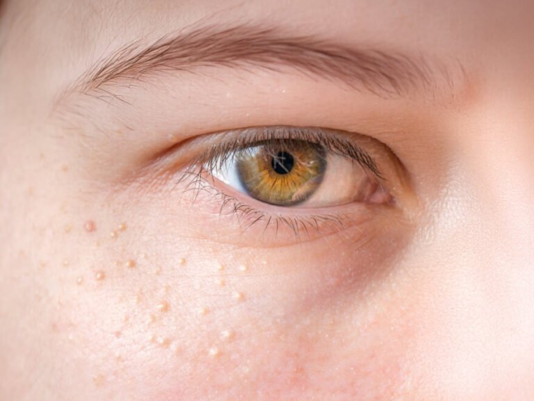 Petit point blanc sur la peau du visage observé en consultation esthétique