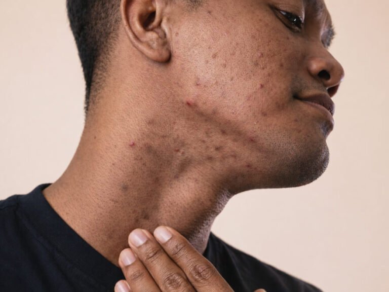 Poils incarnés: prévention, traitement et signes d'alerte