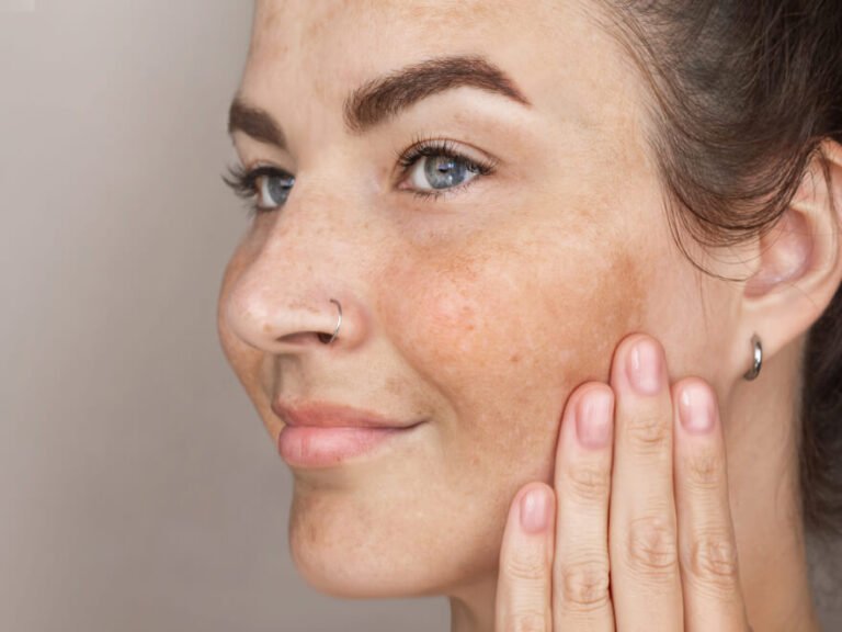 Tache pigmentaire: causes, types et traitements efficaces