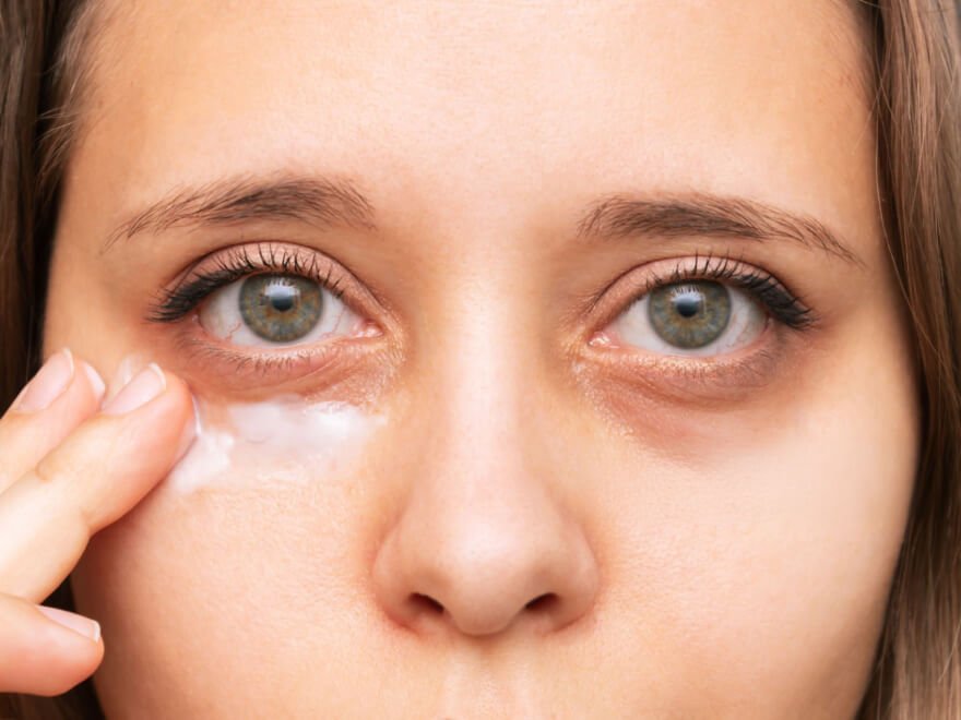 Analyse clinique du contour des yeux avec cernes bleus, marrons et creux