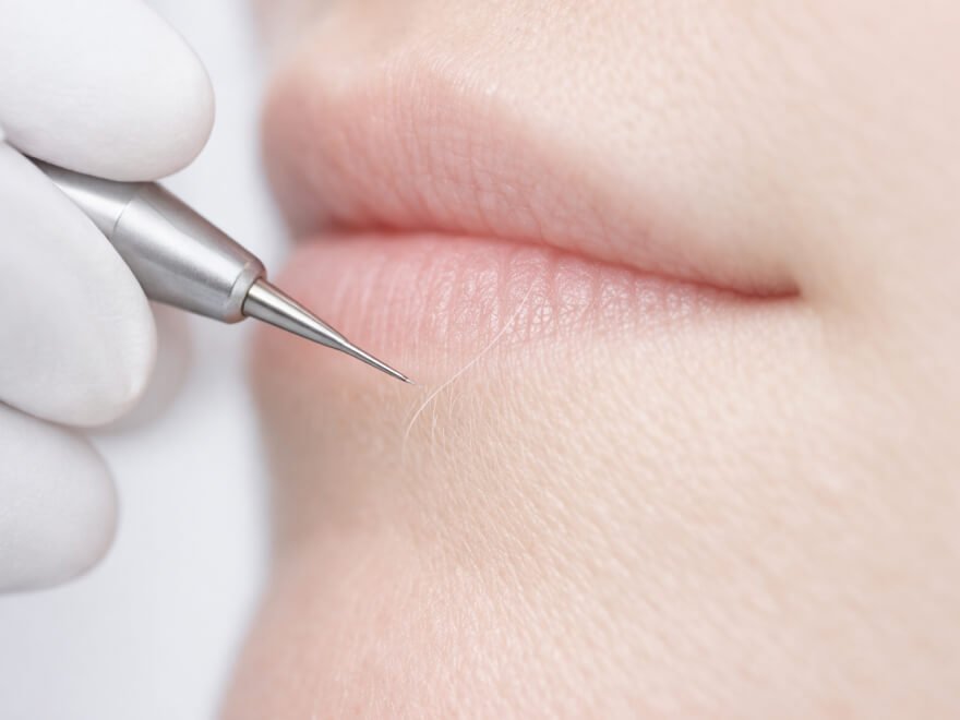 Électrolyse poils blancs et blonds — traitement définitif au cabinet Lazko Beauty Rueil-Malmaison